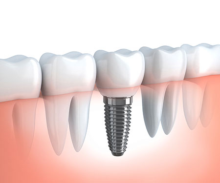 Dental Implants, Brooklyn Newport NS Dentist